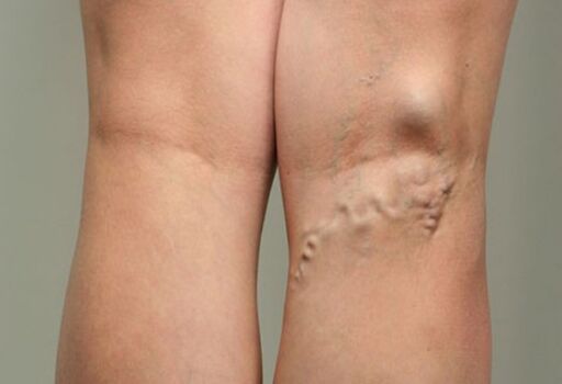 Venna disease