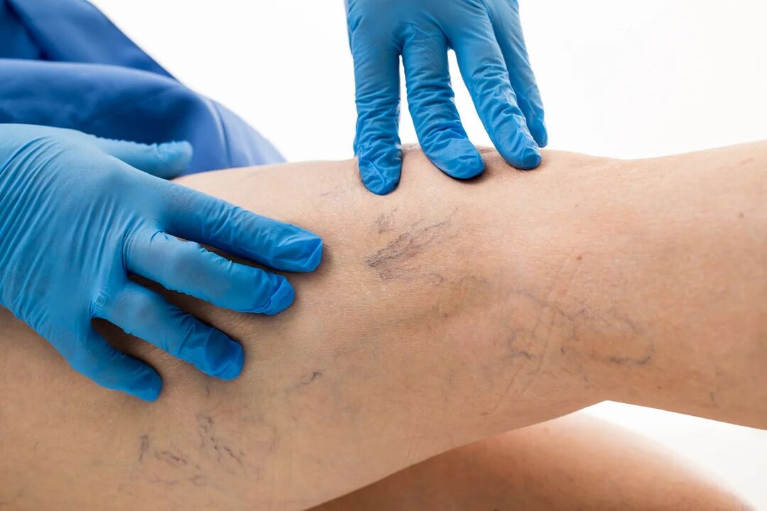 Varicosis network