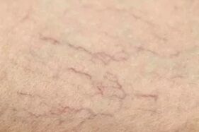 Vascular stars