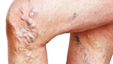 The main manifestations of varicose veins on their feet