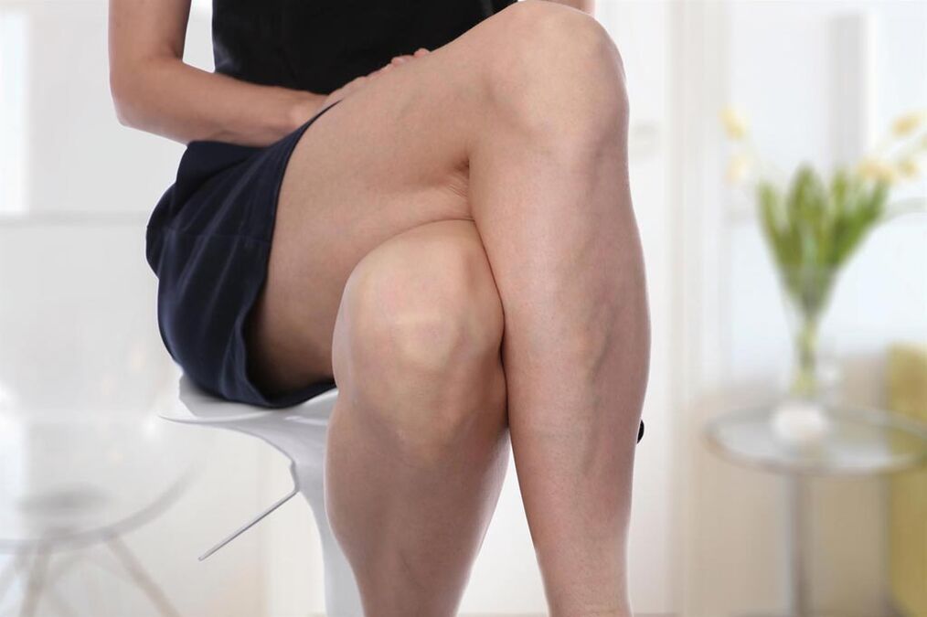 Varicose veins in women