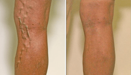 varicose veins in stage 1 and 3 of development