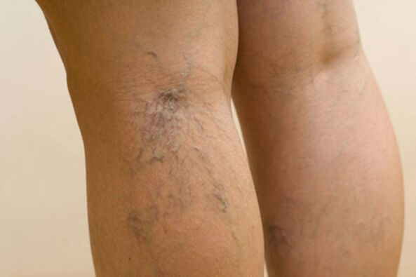varicose veins on female legs