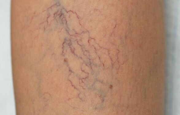 varicose veins on the legs in women