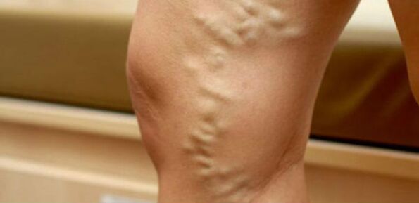 varicose veins on the legs of women