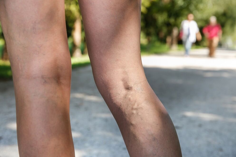 varicose veins on the legs