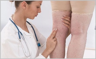The woman consulted a doctor with clear signs of varicose veins