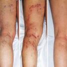 Varicose veins on the legs