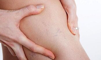 reasons for the development of varicose veins on the legs