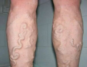 3rd degree varicose veins on the legs