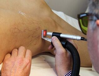contraindications for laser treatment of varicose veins