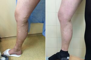 laser treatment of varicose veins before and after photographs