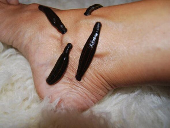 Treatment of varicose veins in the legs of leeches