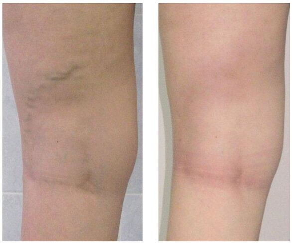 leg veins before and after treatment of varicose veins