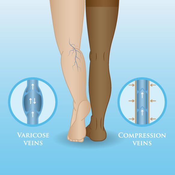 Effects of compression garment on varicose veins in the legs