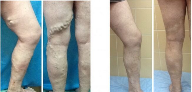 Legs before and after radiofrequency obliteration of varicose veins