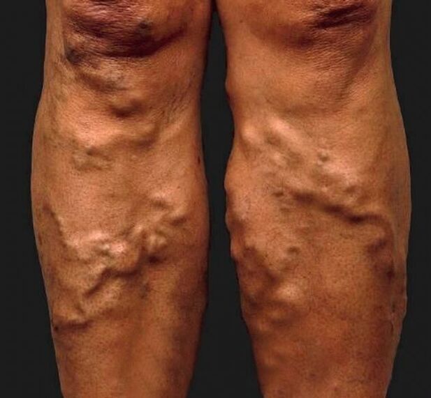 neglected varicose veins in the legs