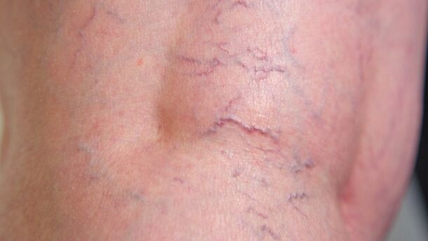 Signs of reticular varicose veins of the lower extremities - dilation of fine veins and vascular network