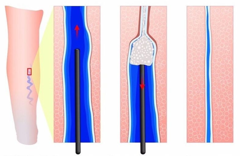 sclerotherapy of varicose veins in the legs in men